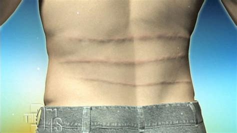 Male Stretch Marks The Doctors Tv Show