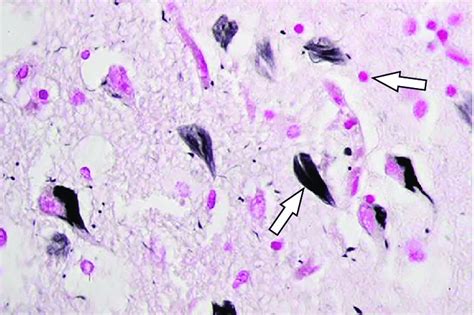 amyloid plaques pink  neurofibrillary tangles black