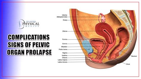 Symptoms And Treatments Of Pelvic Organ Prolapse Comprehensive Guide