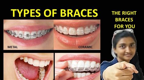 Types Of Braces Pros And Cons Best Braces For Teeth Youtube