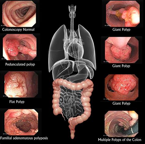 Colon Cancer Know The Symptoms And Risk Factors People