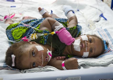 Conjoined Twins A Zhari And A Zhiah Jones Separated In Rare Phased