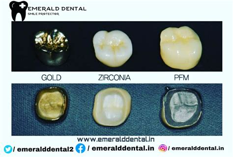 zirconia dental crowns emerald dental