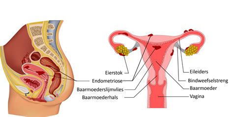 endometriose folder catharina ziekenhuis