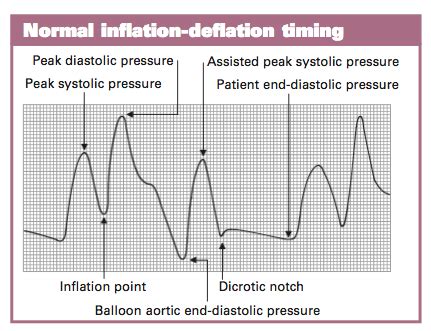 optimal timing  inflating  deflating  iabp balloon