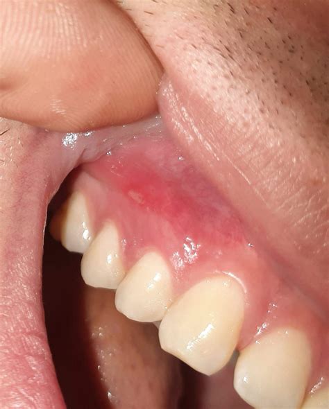 aphten zahnfleisch gesundheit zahnarzt mund