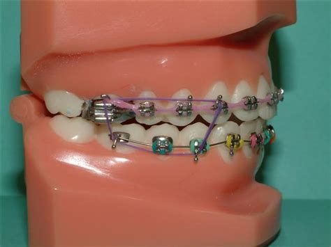 elastics braces  henry braces  henry