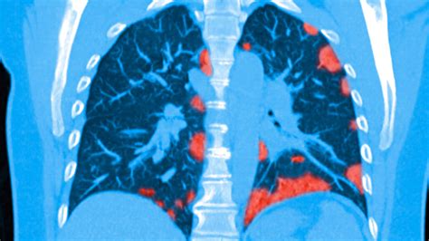 patients  survive covid   suffer lasting lung damage