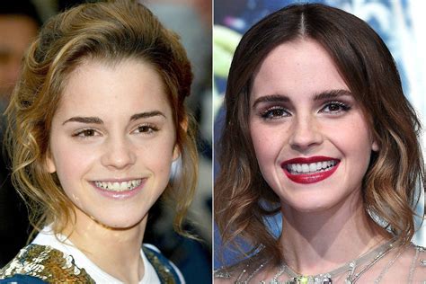 celebrity teeth   teeth whitening makeovers pictures  glamour uk