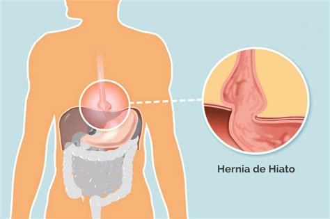 síntomas y tratamiento de la hernia de hiato ocu