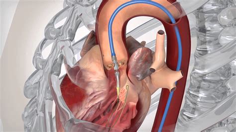 Narrowing Aortic Valve Can Be Treated Without Open Heart Surgery Upmc