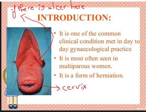 8 Questions With Answers In Uterine Prolapse Science Topic