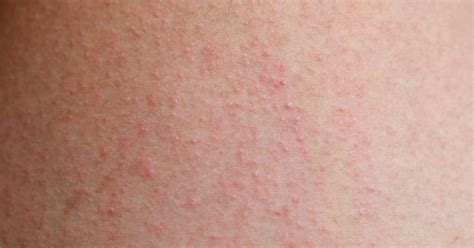 How To Dry Eczema Livestrong