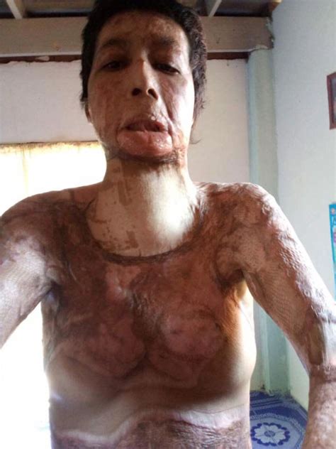 thai mum s face melts off after husband set her alight