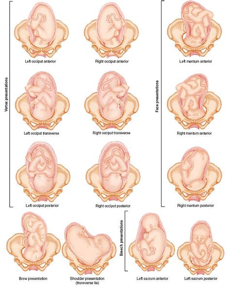 fetal positions nursingnclex pinterest midwifery ob nursing