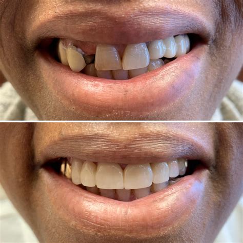 dental bridges orillia  replacement teeth