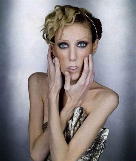 5 Famous Models Who Suffered From Anorexia