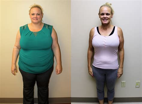 Gastric Sleeve Before And After In St Louis St Louis