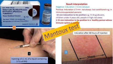mantoux test introduction procedure normal range  result interpret