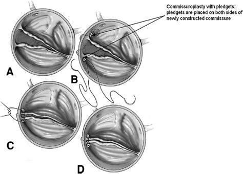 The Sievers Classification Of The Bicuspid Aortic Valve For The