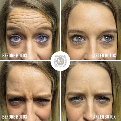 patient   units  botox  forehead wrinkles frown lines