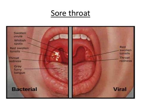inflammation in throat tube natural tits