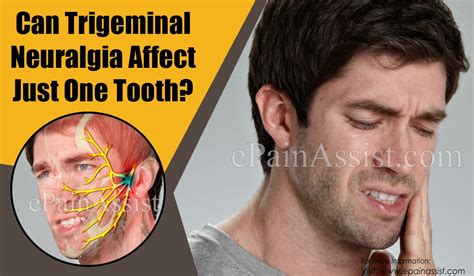 trigeminal neuralgia affect   tooth    swelling