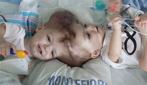 conjoined twins pictured staring at each other for the first time