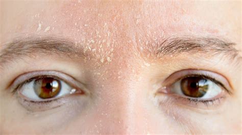 tips  treating dry  flaking skin   face gladskin