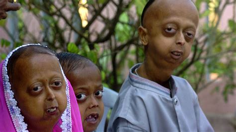 video comment proteger de la progeria ce vieillissement accelere
