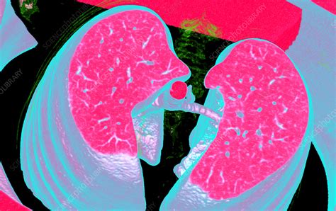 Healthy Lungs Ct Scan Stock Image C057 7821 Science Photo Library
