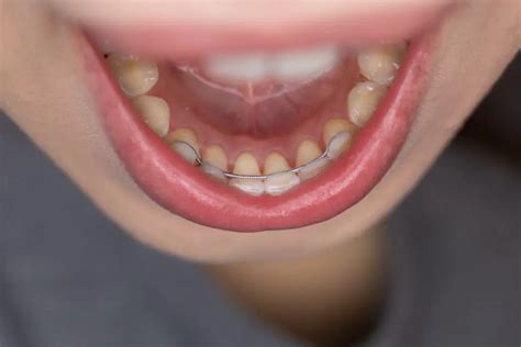 When Can I Wear My Retainer After Wisdom Teeth Removal Teethandtooth