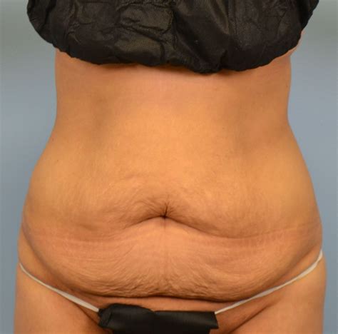 how to tighten loose skin without surgery