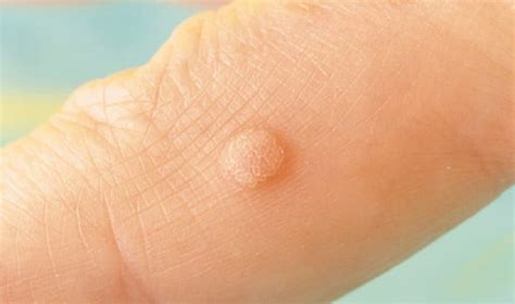 here s 25 ways to naturally resolve skin tags warts