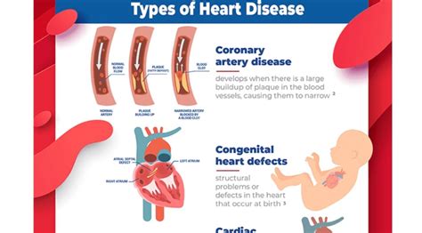 heart disease chart
