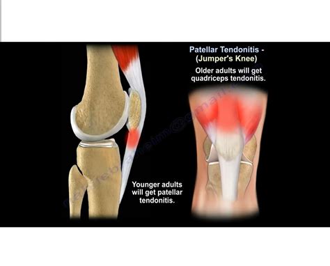 patellar tendinitis jumpers knee orthopaedicprinciplescom