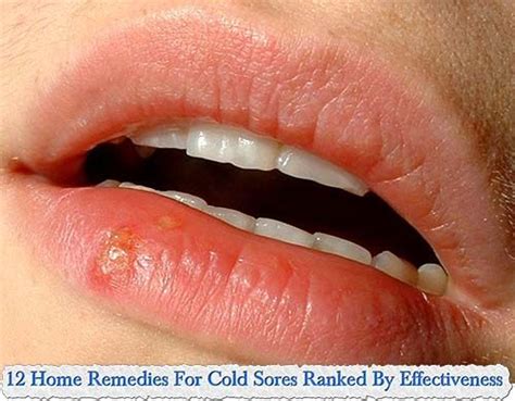 12 Home Remedies For Cold Sores Ranked By Effectiveness My Style