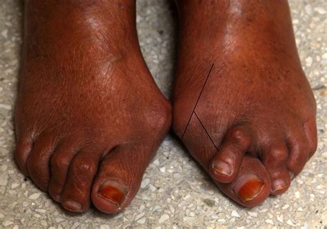 ‘scissor Deformity’ Of The Toes Bmj Case Reports