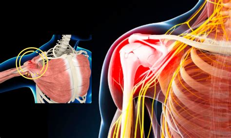 shoulder impingement syndrome osteo health osteopath clinic  calgary