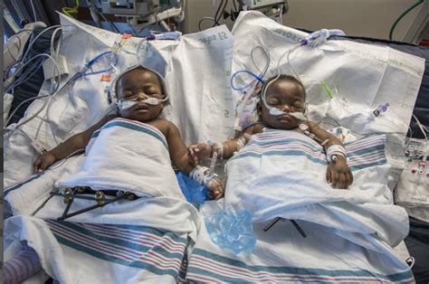 Conjoined Nigerian Twins Finally Separated Photos