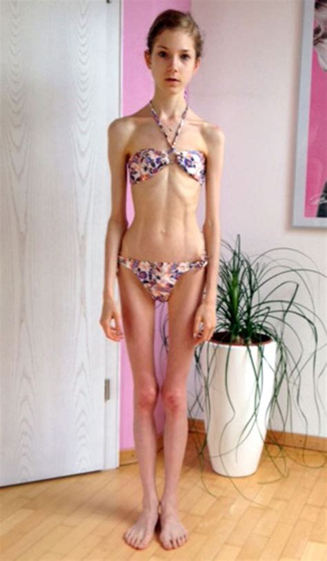 Girl Battling Anorexia Who Weighed Just Three And A Half Stone Says