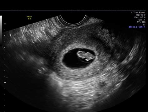 Pregnancy Dating Ultrasound 7 Weeks