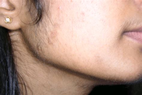 5 Causes Of Excess Facial Hair In Women Lady Care Health