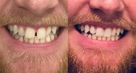gap teeth ataligners