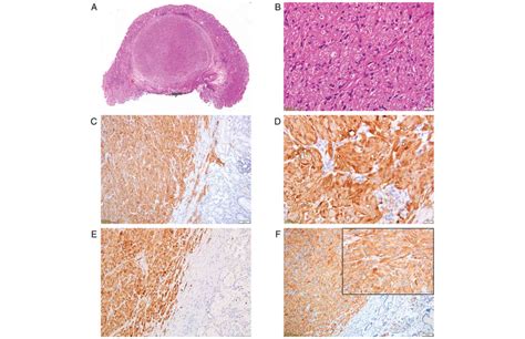 unexpected diagnosis   gastric polyp granular cell tumor case