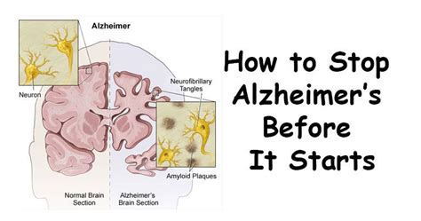10 things to do to prevent alzheimer s disease