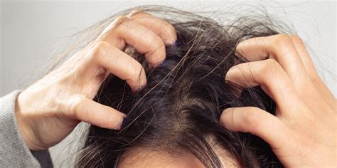 itchy scalp   treatments