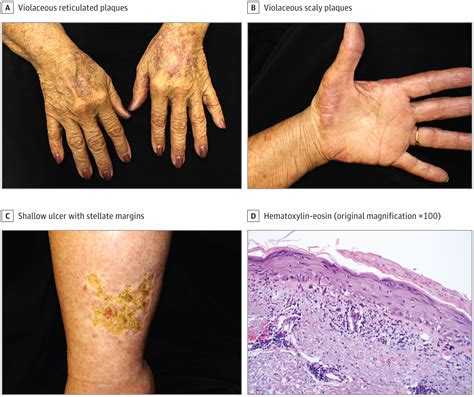 violaceous photodistributed cutaneous eruption and leg ulcer