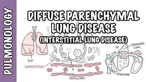 Interstitial Lung Disease Ild Classification Pathophysiology