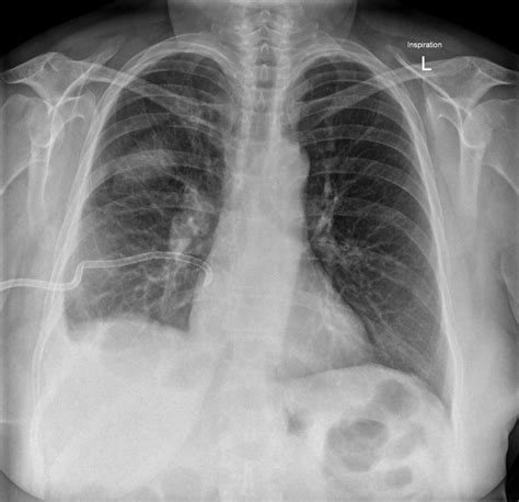 loculated pleural effusion loculated pleural effusion chest  ray